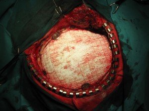 Ryc.5. Implantacja przygotowanej protezy